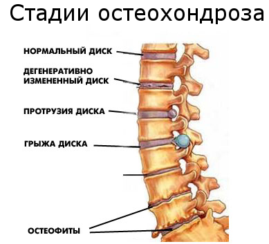 Что такое остеохондроз - Виды, симптомы и лечение